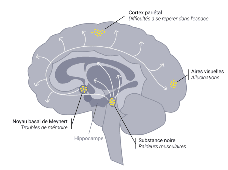 Démence à corps de Lewy évolution, espérance de vie